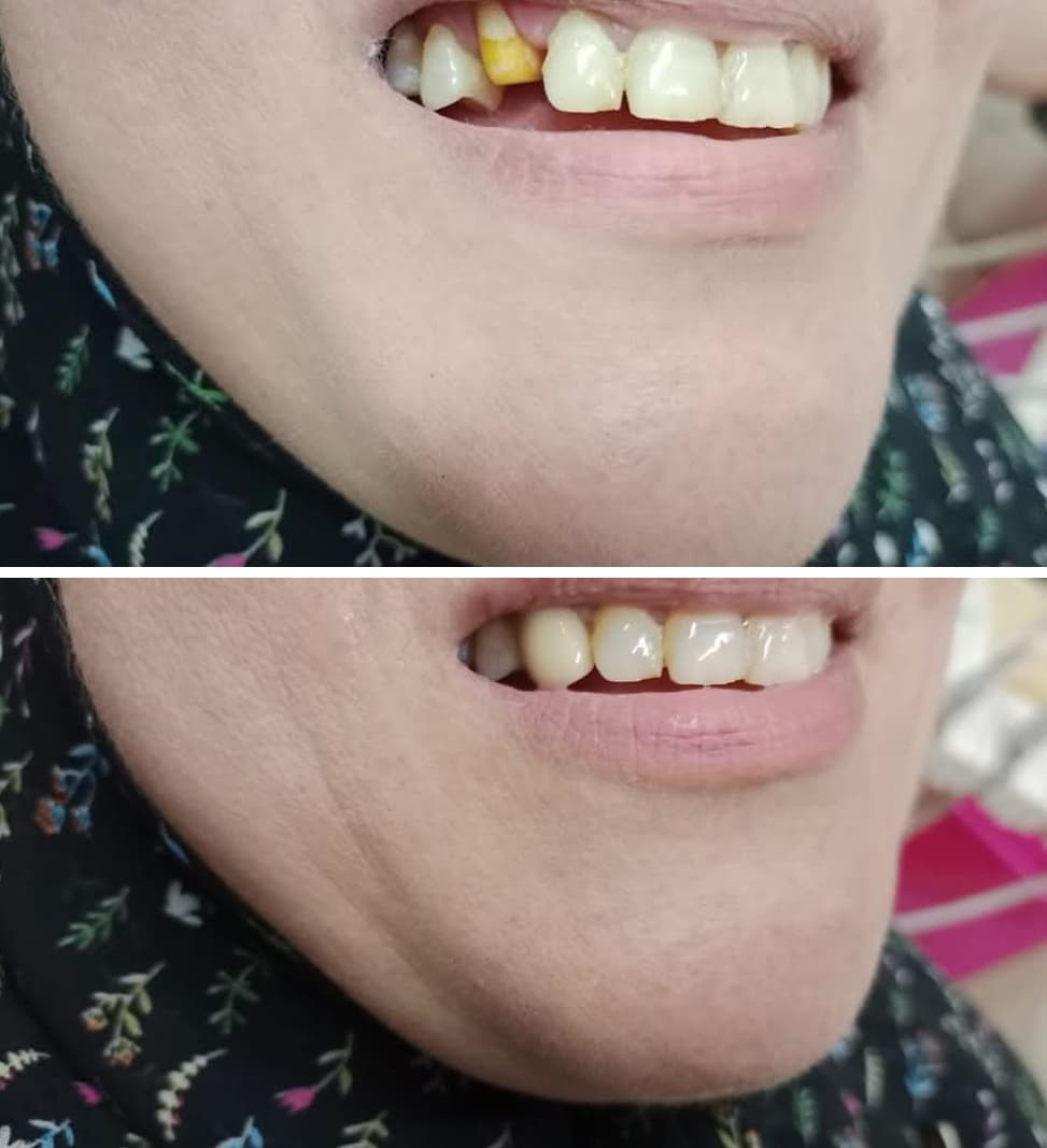 Before and after comparison of a dental procedure restoring a broken and discolored front tooth.