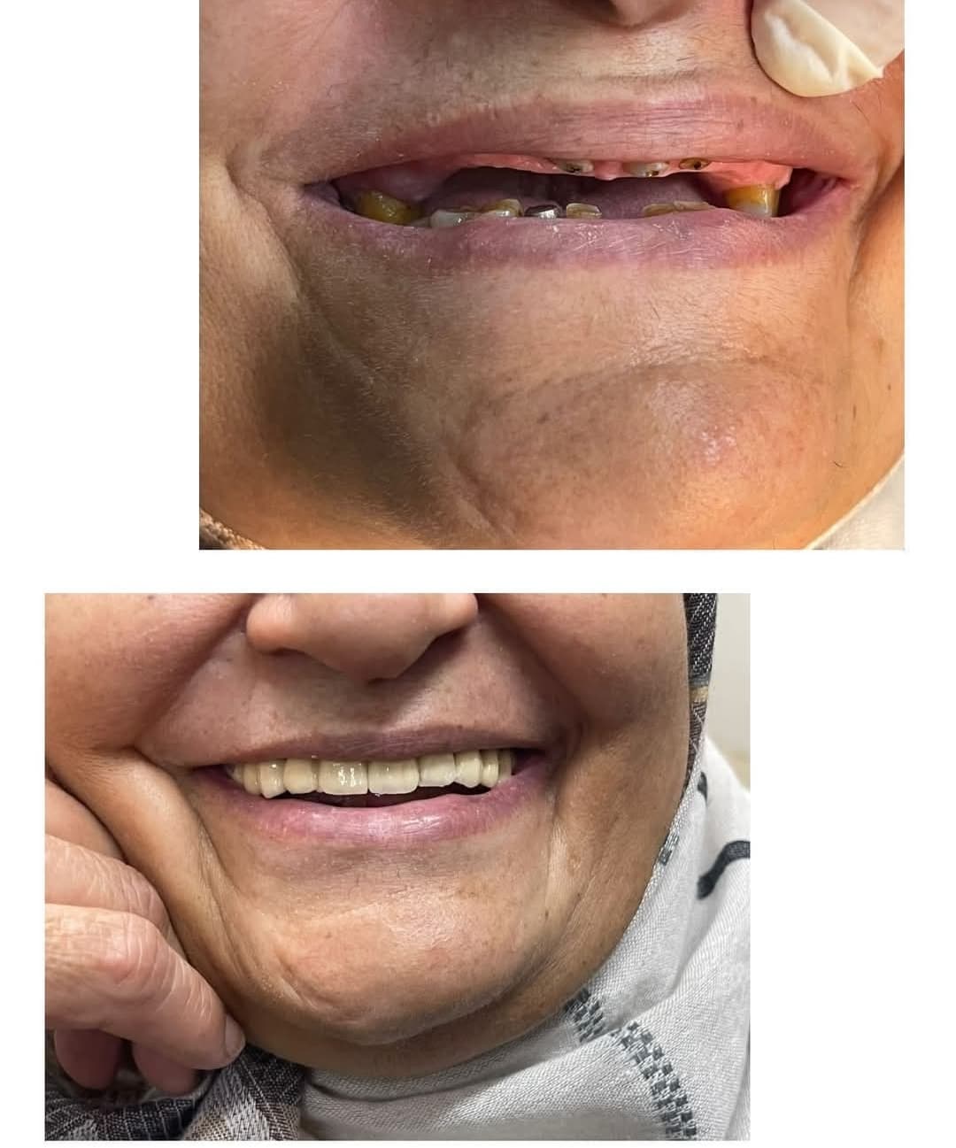 Before and after comparison showing dental restoration from severely decayed teeth to a healthy smile.